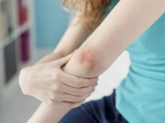 psoriasis DMLA