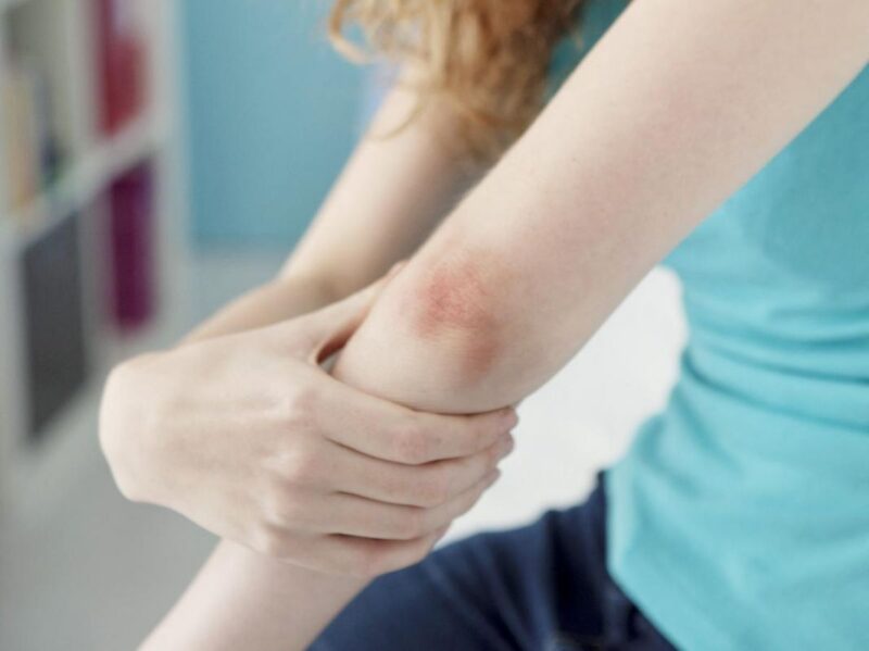 psoriasis DMLA