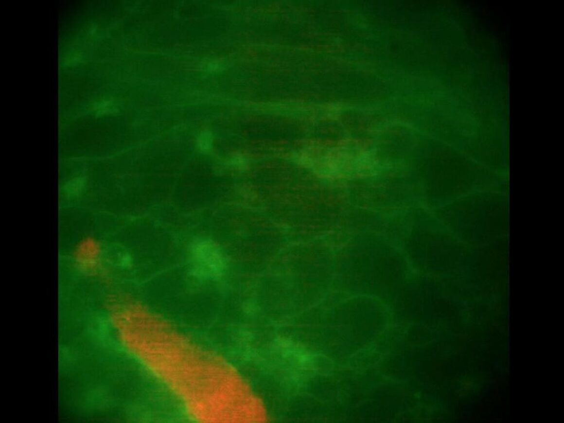 Fibrillation auriculaire