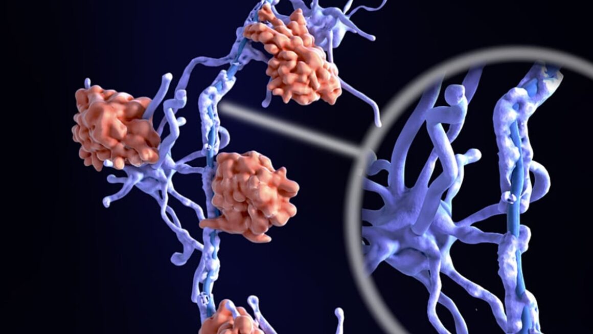 sclérose en plaques