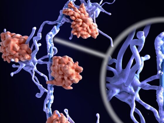 sclérose en plaques