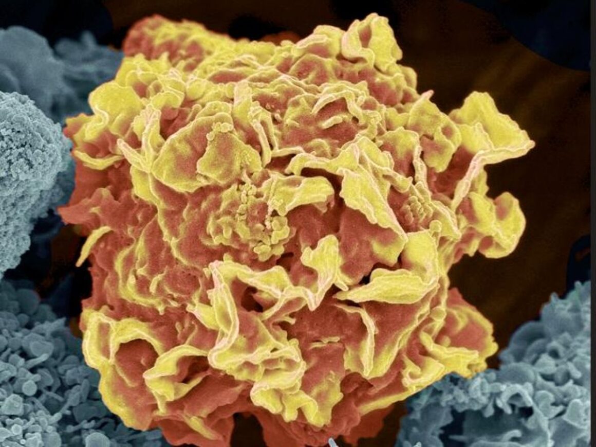 IA générative cancer