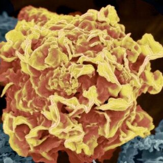 IA générative cancer