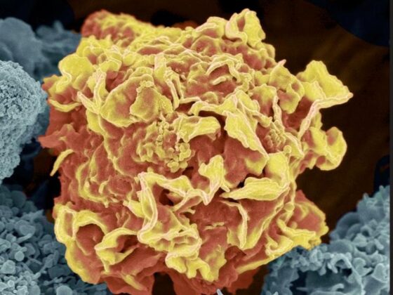 IA générative cancer