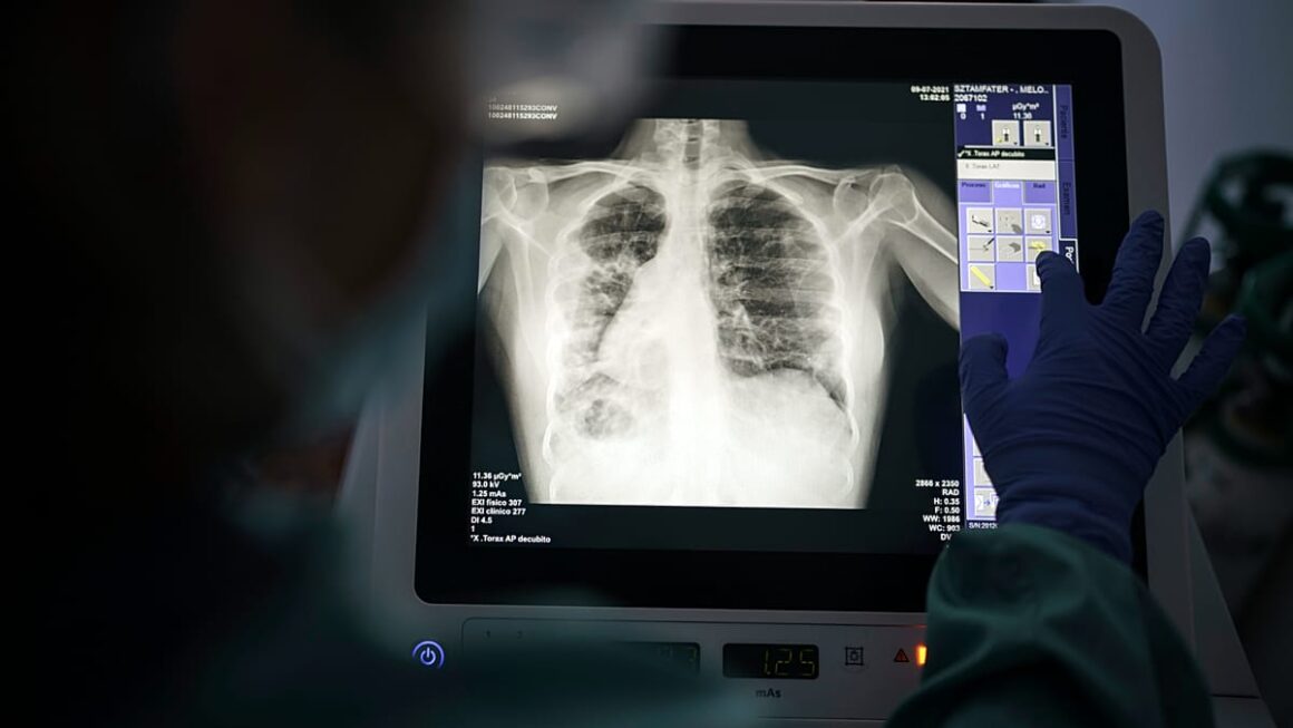 tuberculose en Europe