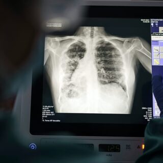 tuberculose en Europe