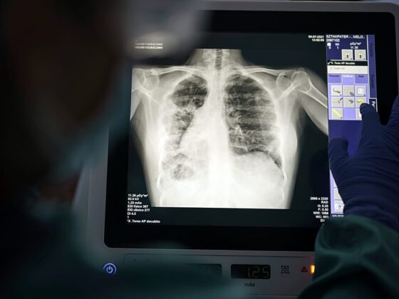 tuberculose en Europe